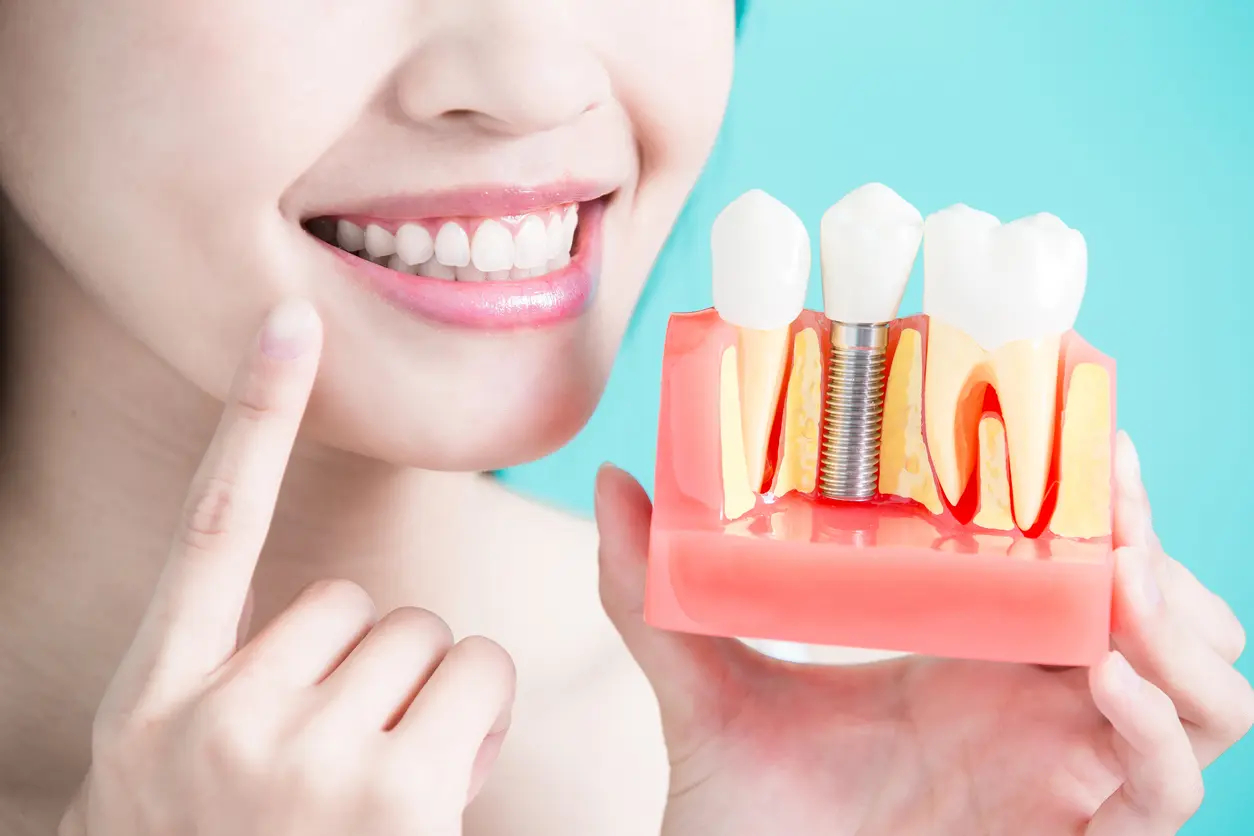 Trồng răng Implant bao lâu thì ăn được? Nên ăn và kiêng gì sau khi làm Implant?