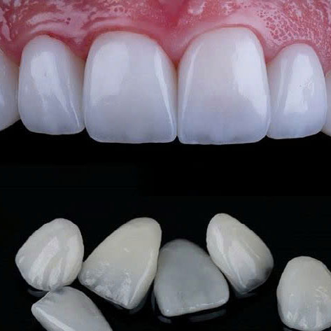 Dan su veneer Lisi Press