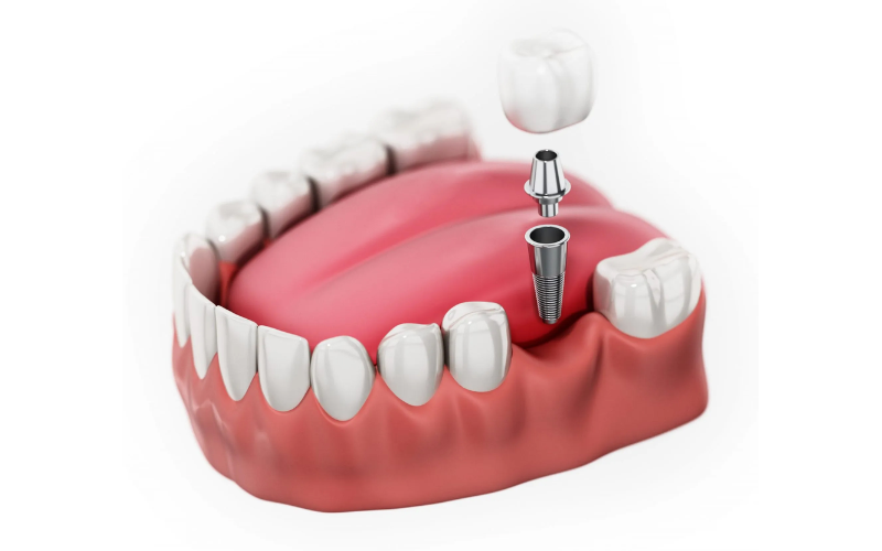 cay ghep implant don le 01