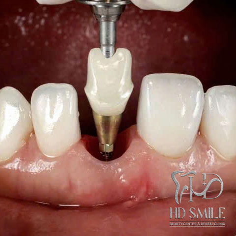 cay ghep implant rang le03
