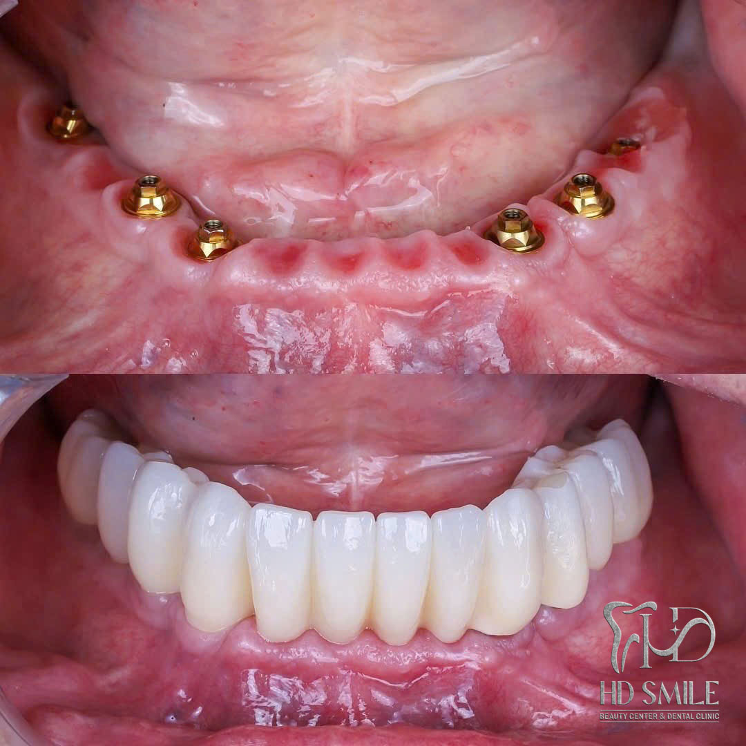cay ghep implant toan ham02