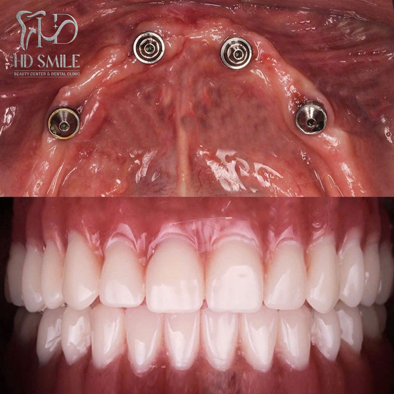 cay ghep implant toan ham03