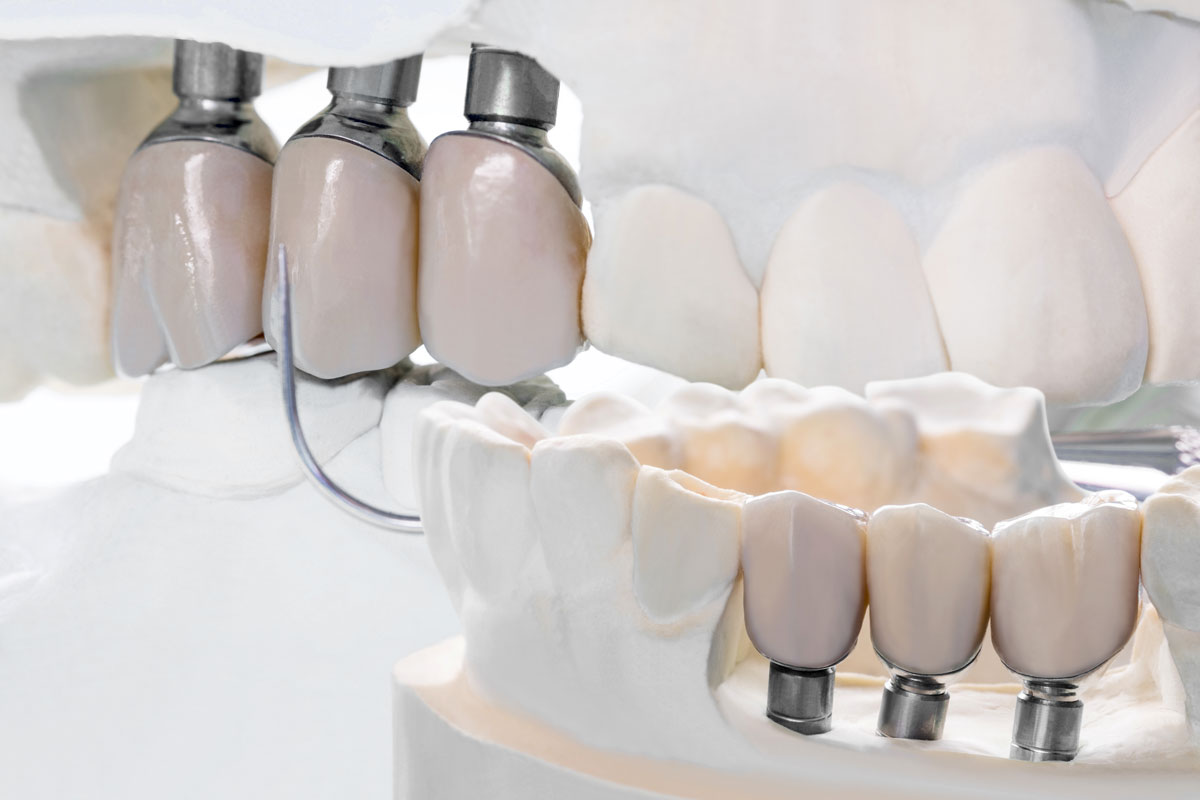 close-up-implant-model-tooth-support-fix-bridge-implant-crown