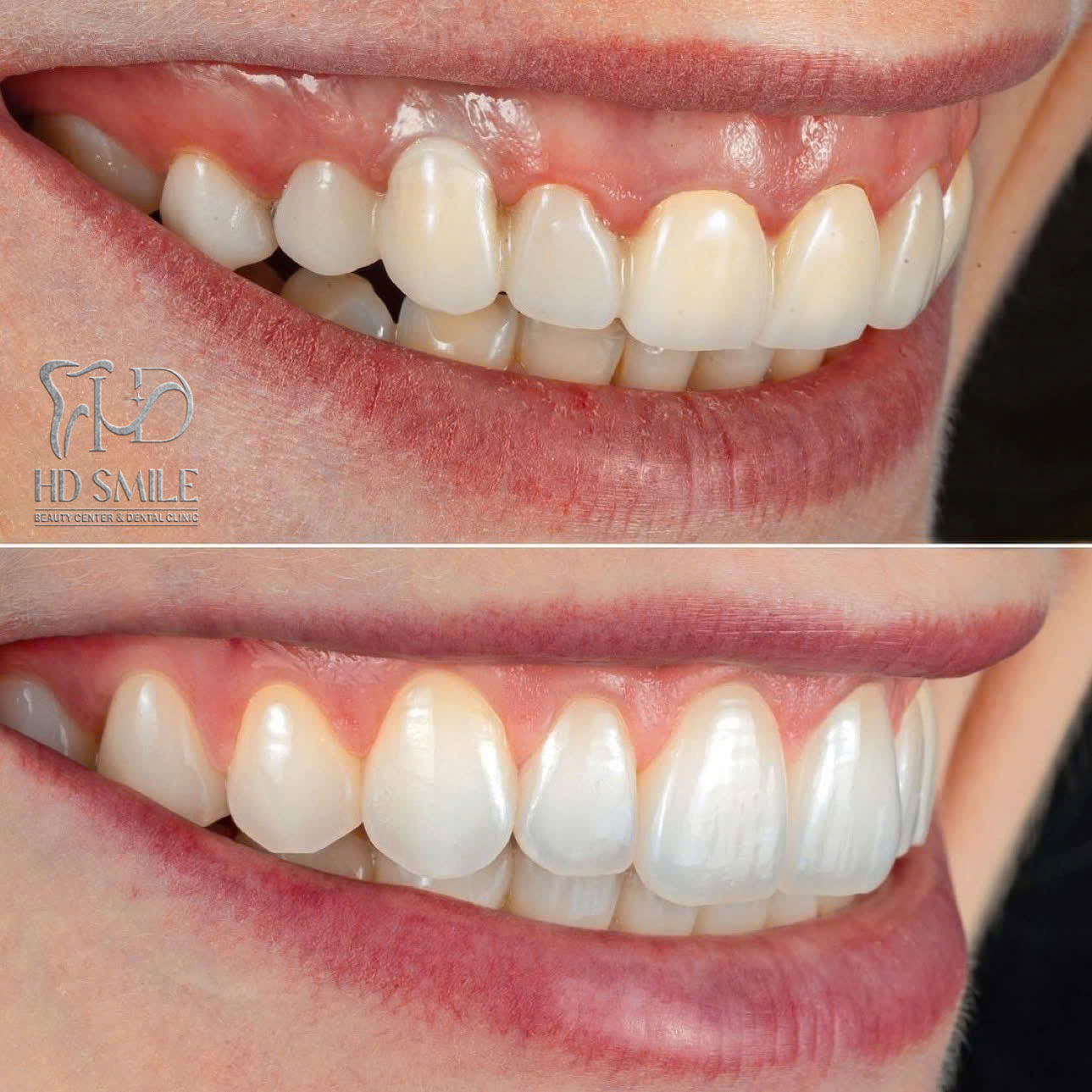 dan su veneer 3