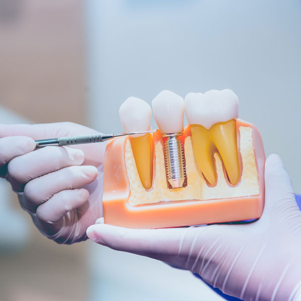 implant rang le01