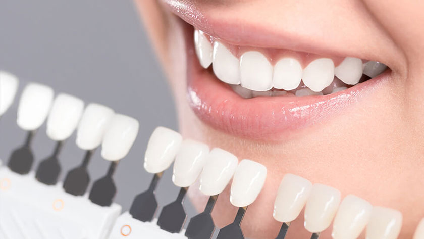 su veneer giai phap cho ham rang dep